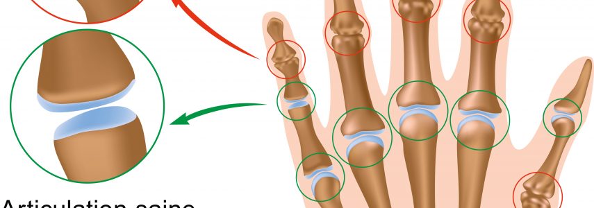 L’arthrose de la main et du genou