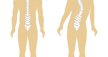 La scoliose, c’est quoi ?